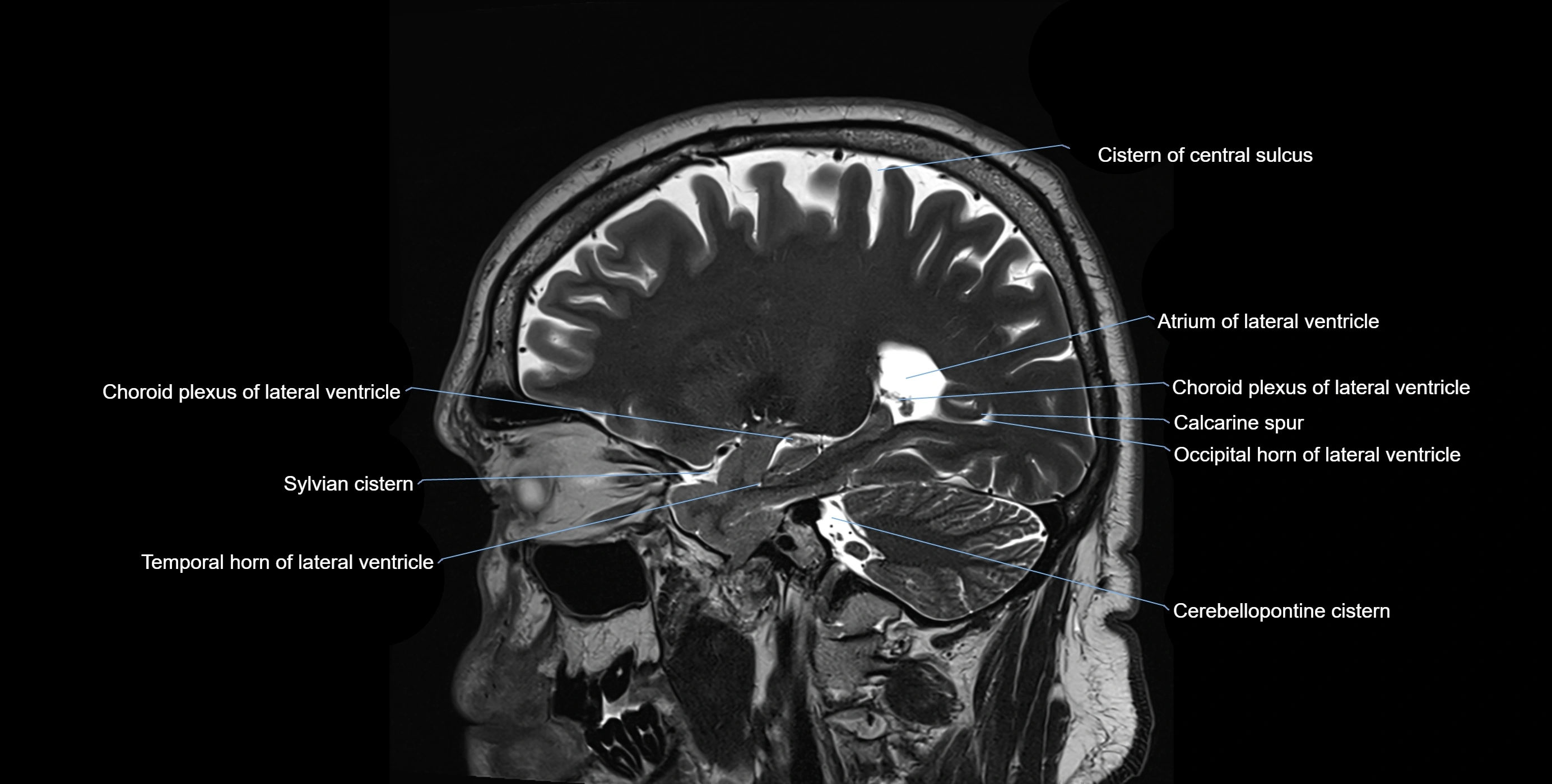 Brain cisterns  and ventricles sagittal anatomy 3T MRI image-img-00001-00018.webp